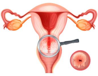 Cáncer de cuello uterino
