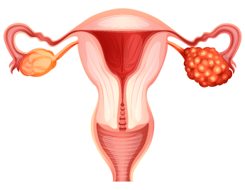 Cáncer de ovario