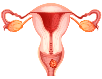 Cáncer vaginal